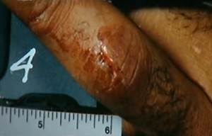 OJ Simpson - Verletzung Mittelfinger
