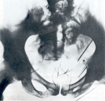Albert Fish - Nadeln - Röntgenbild
